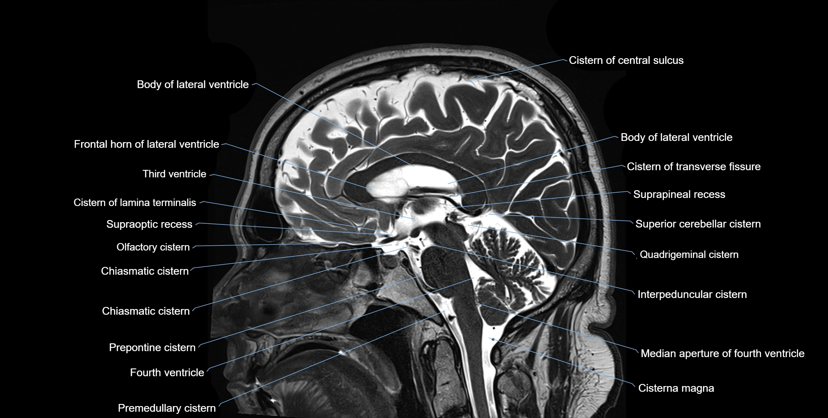 Brain cisterns  and ventricles sagittal anatomy 3T MRI image-img-00001-00028.webp